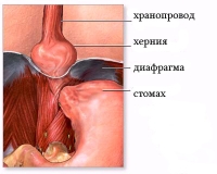 Хиатален пролапс