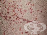 ������� �� �������-����� (Schönlein-Henoch purpura)