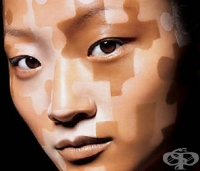 лечение на витилиго с хомеопатия