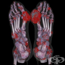 подагра възраст