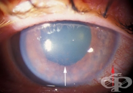 първична глаукома със затворен ъгъл