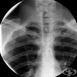 Ð¨Ð¸Ð¹Ð½Ð¾ Ñ€ÐµÐ±Ñ€Ð¾ - Ð¸Ð·Ð¾Ð±Ñ€Ð°Ð¶ÐµÐ½Ð¸Ðµ