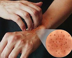plant dermatitis home remedy