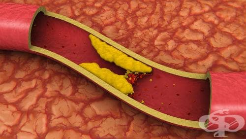 Изследване на LDL-холестерол - изображение