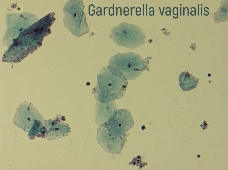 Gardnerella vaginalis