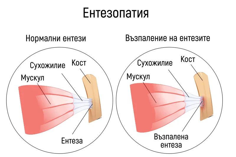 Какво е ентезопатия? Какво е ентезопатия?
