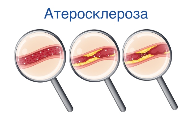 Снимка на атеросклероза при повишени нива на серумния фибриноген Снимка на атеросклероза при повишени нива на серумния фибриноген