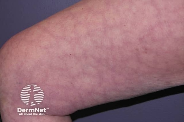 Cutis marmorata Cutis marmorata