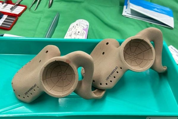 Израелските лекари създават персонализиран 3D имплант на таза, който поставят на мястото на отстранения, след като са извадили тумора. 3D импланта на таза на Марк