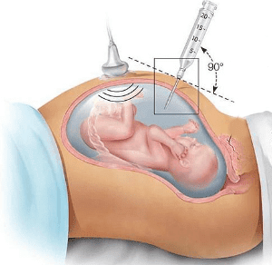 amniocentesis
