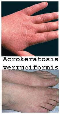 Acrokeratosis verruciformis