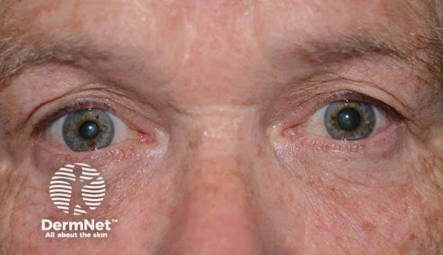 Симптоми при анизокория Симптоми при анизокория