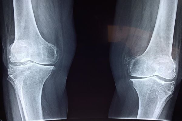 рентгенова снимка на коленни стави