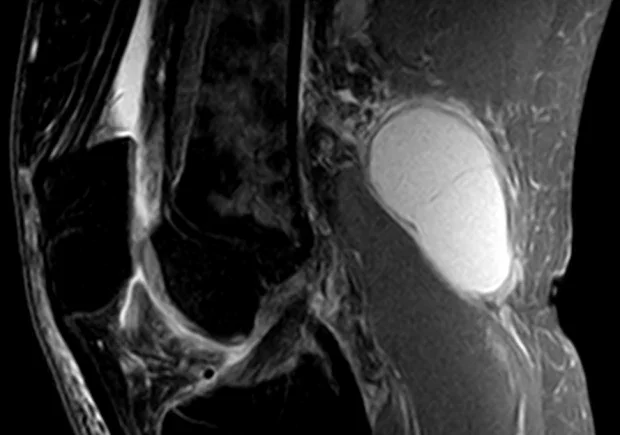 Ядрено-магнитен резонанс, показващ киста на Бейкър Ядрено-магнитен резонанс, показващ киста на Бейкър