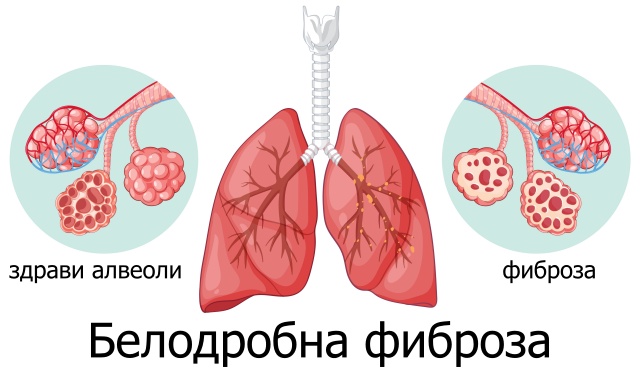 Белодробна фиброза Белодробна фиброза