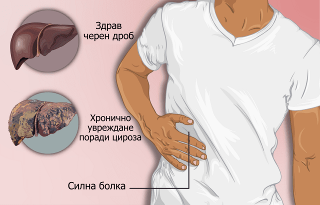 Фиброзиране на черния дроб при цироза Фиброзиране на черния дроб при цироза