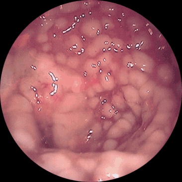 �����, ����������� �� Clostridium difficile