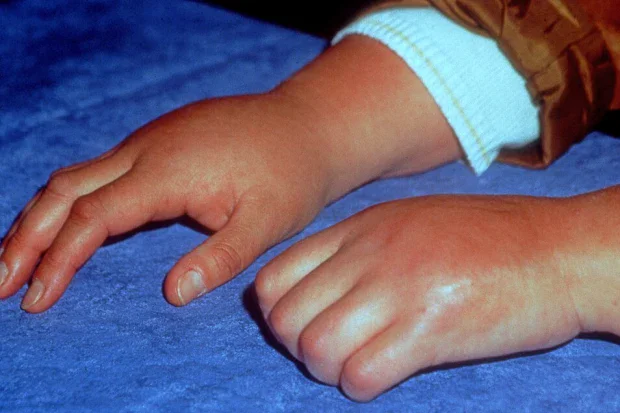 Симптоми на синдром на комплексна регионална болка Симптоми на синдром на комплексна регионална болка