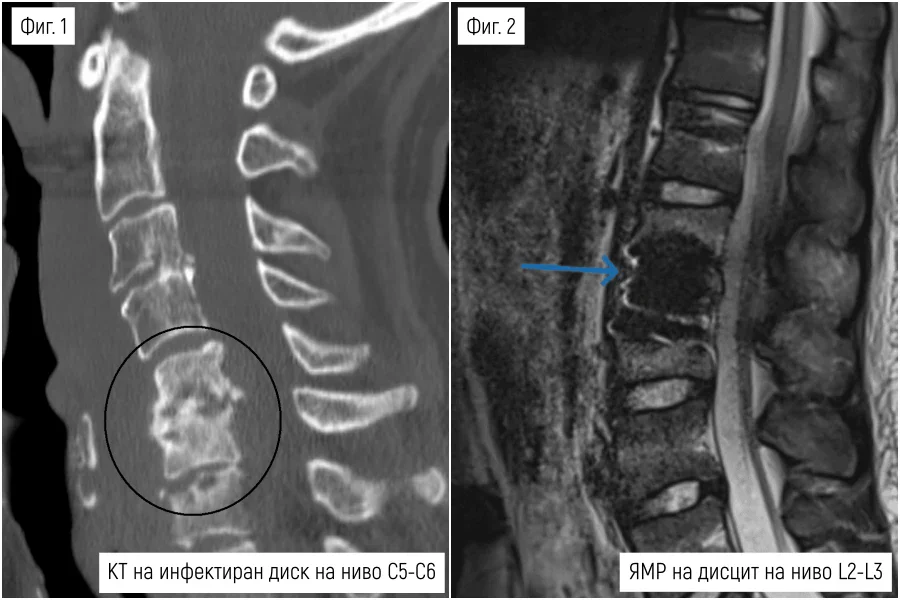 ЯМР и КТ, показващи спондилодисцит ЯМР и КТ, показващи спондилодисцит