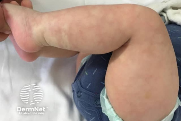 Cutis marmorata telangiectatica congenita Cutis marmorata telangiectatica congenita