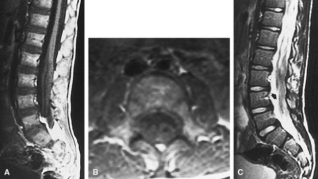 MR Imaging of Dejerine-Sottas Disease