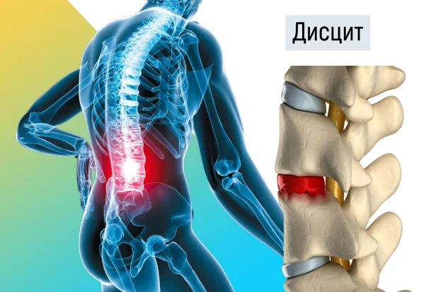 Болка при дисцит Болка при дисцит