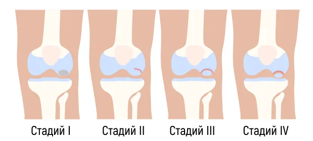 Стадии на дисекиращ остеохондрит Стадии на дисекиращ остеохондрит