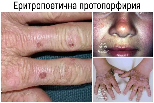 Еритропоетична протопорфирия Еритропоетична протопорфирия