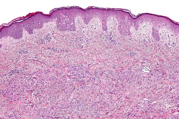 ���������� �� granuloma annulare