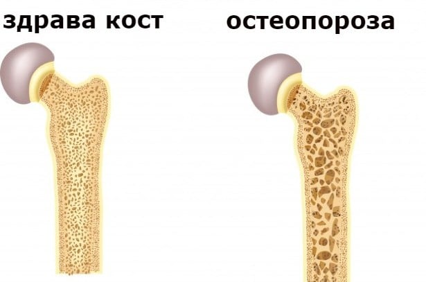 Характерни промени в костите при остеопороза