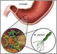   Helycobacter pylori