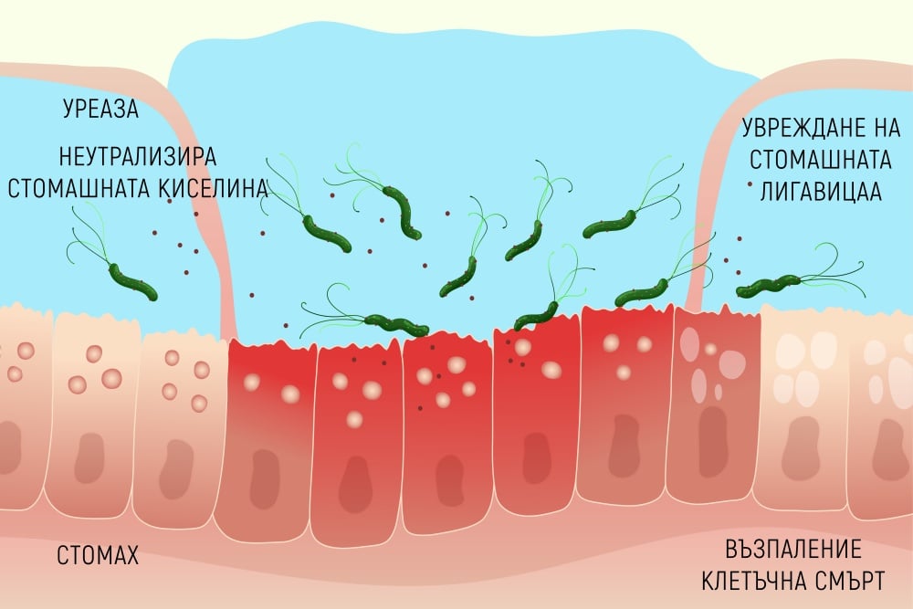  Helicobacter pylori  