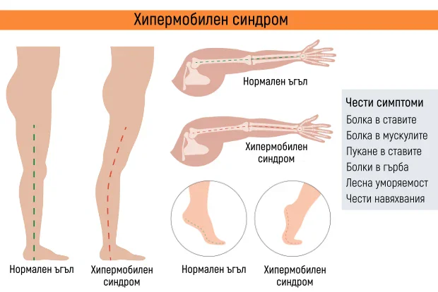 Симптоми при хипермобилен синдром Симптоми при хипермобилен синдром