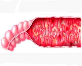 Infection of the intestine