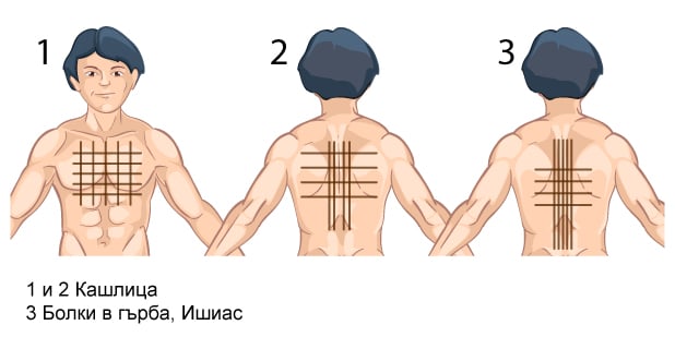 Йодна решетка на гърдите и гърба