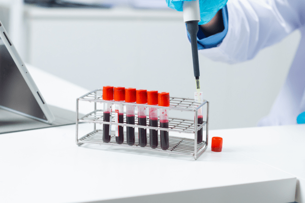 Стойностите на метилиране в белите кръвни клетки показват дали прогестероновата терапия би помогнала на жени с ендометриоза епруветки с кръв