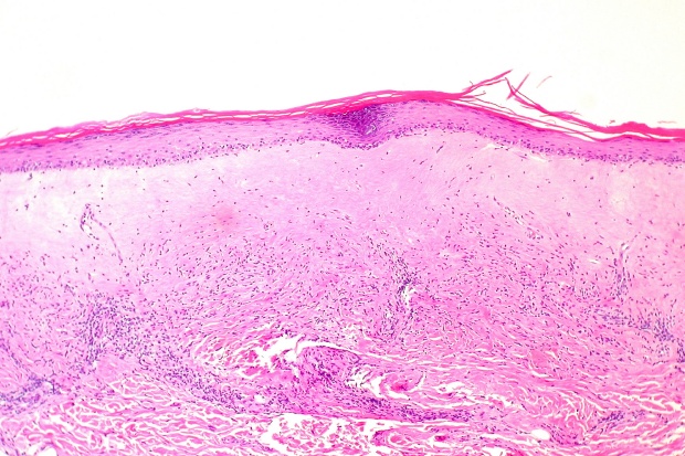 Lichen sclerosus et atrophicus