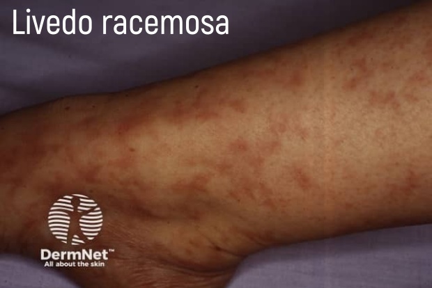 Livedo racemosa Livedo racemosa