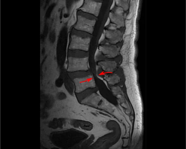 Рентгенова снимка на лумблана спинална стеноза Рентгенова снимка на лумблана спинална стеноза