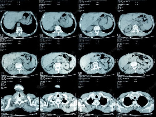 Компютърна томография (КТ) на гръден кош
