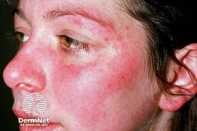 Пеперуден обрив при лупус Пеперуден обрив при лупус