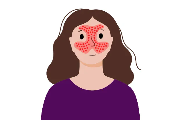 Обрив по лицето с формата на пеперуда Обрив по лицето с формата на пеперуда