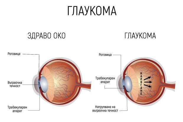 Механизъм на развитие на глаукома