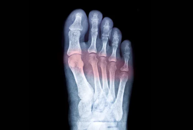 Рентегенова снимка на ходило Рентегенова снимка на ходило
