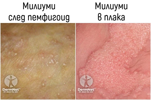 Видове милиуми Видове милиуми