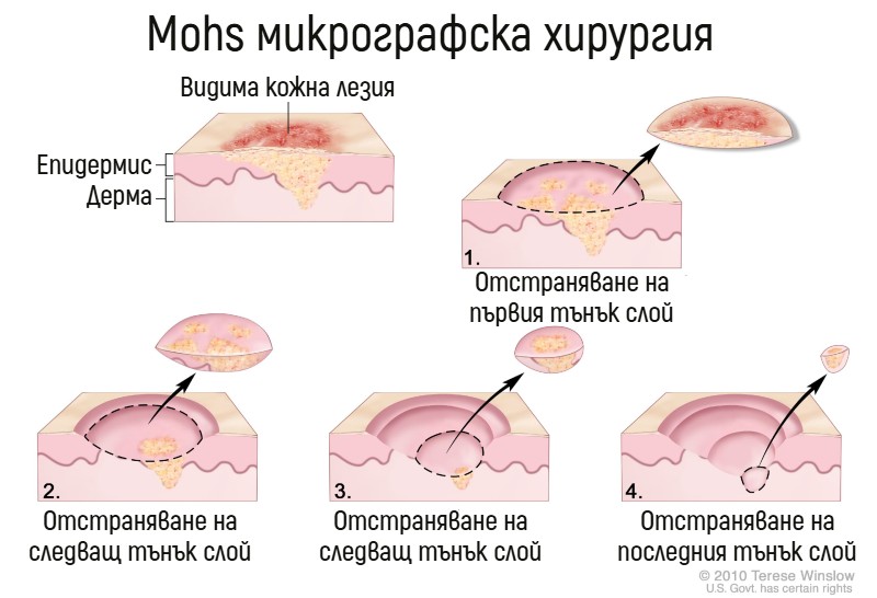 Mohs  