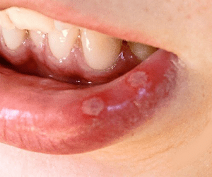 mouth-ulcer