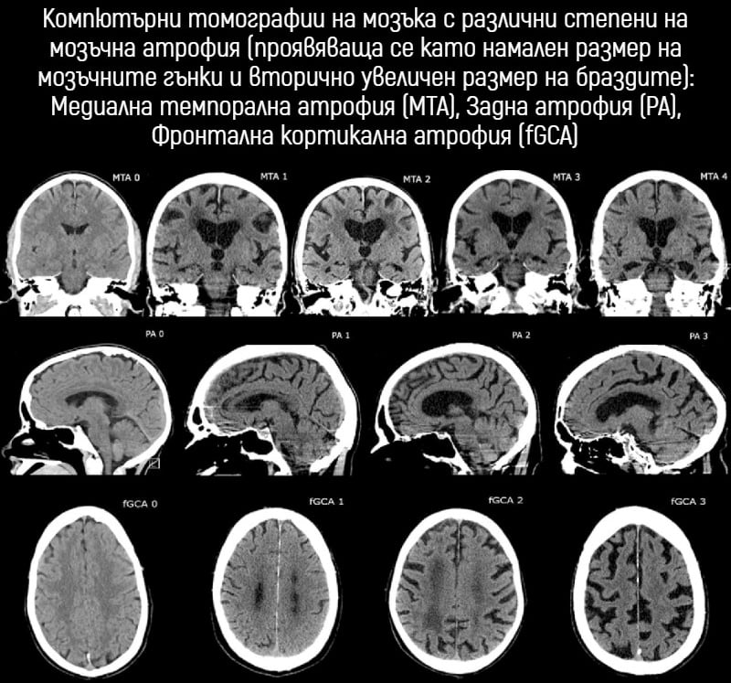 Компютърна томография на мозъчна атрофия Компютърна томография на мозъчна атрофия