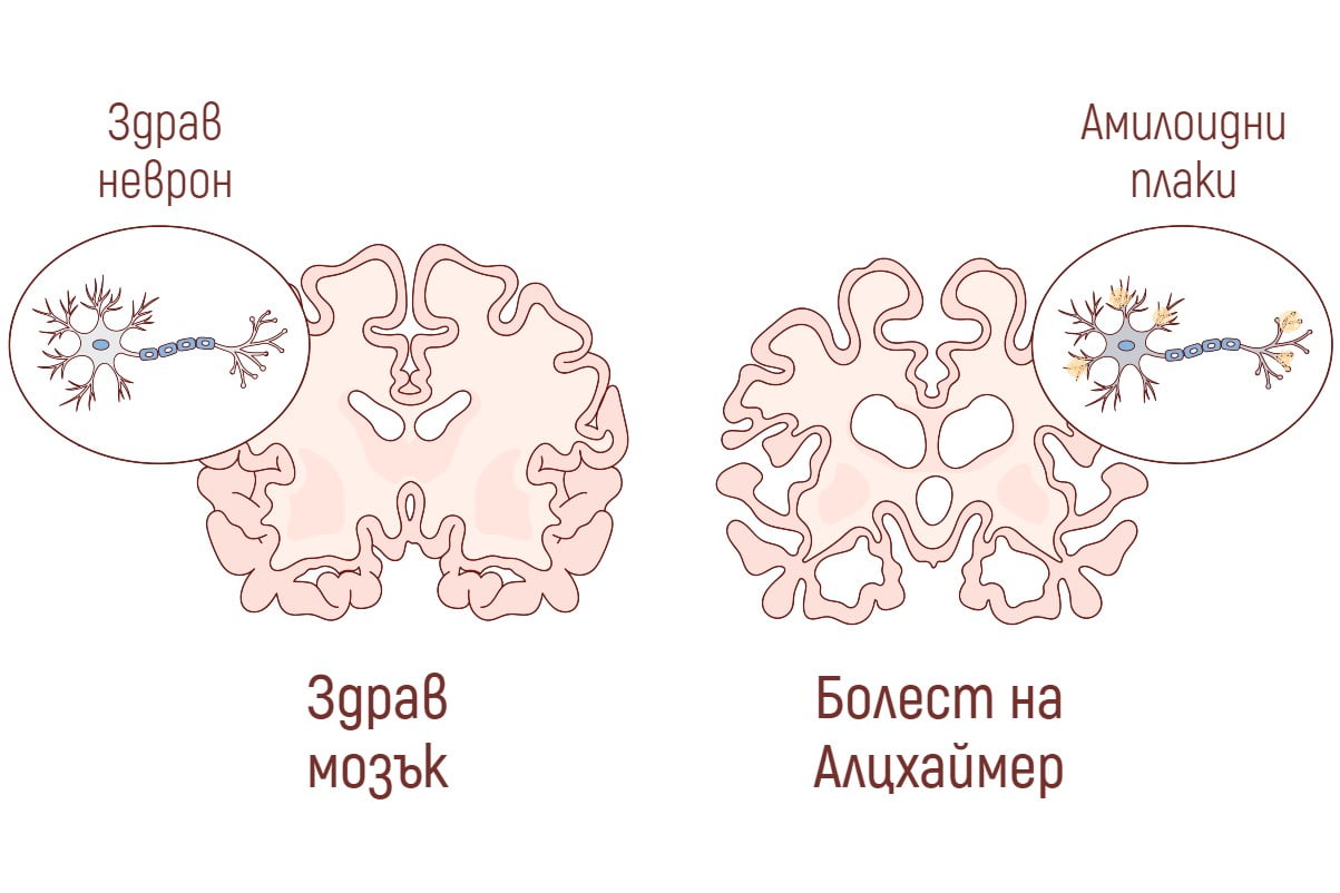 Болест на Алцхаймер Болест на Алцхаймер