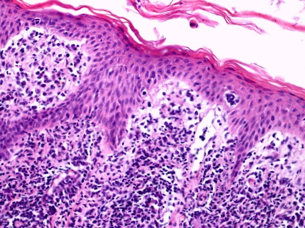 Mycosis fungoides